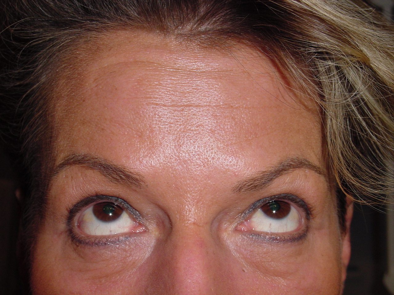 BOTOX